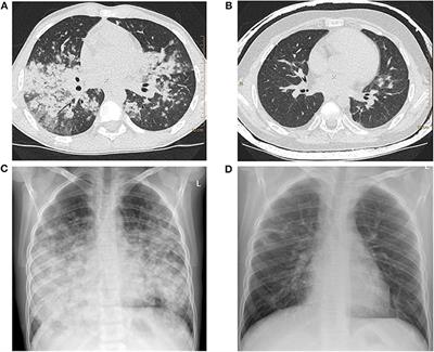 Interstitial Lung Disease in Children With Selected Primary Immunodeficiency Disorders—A Multicenter Observational Study